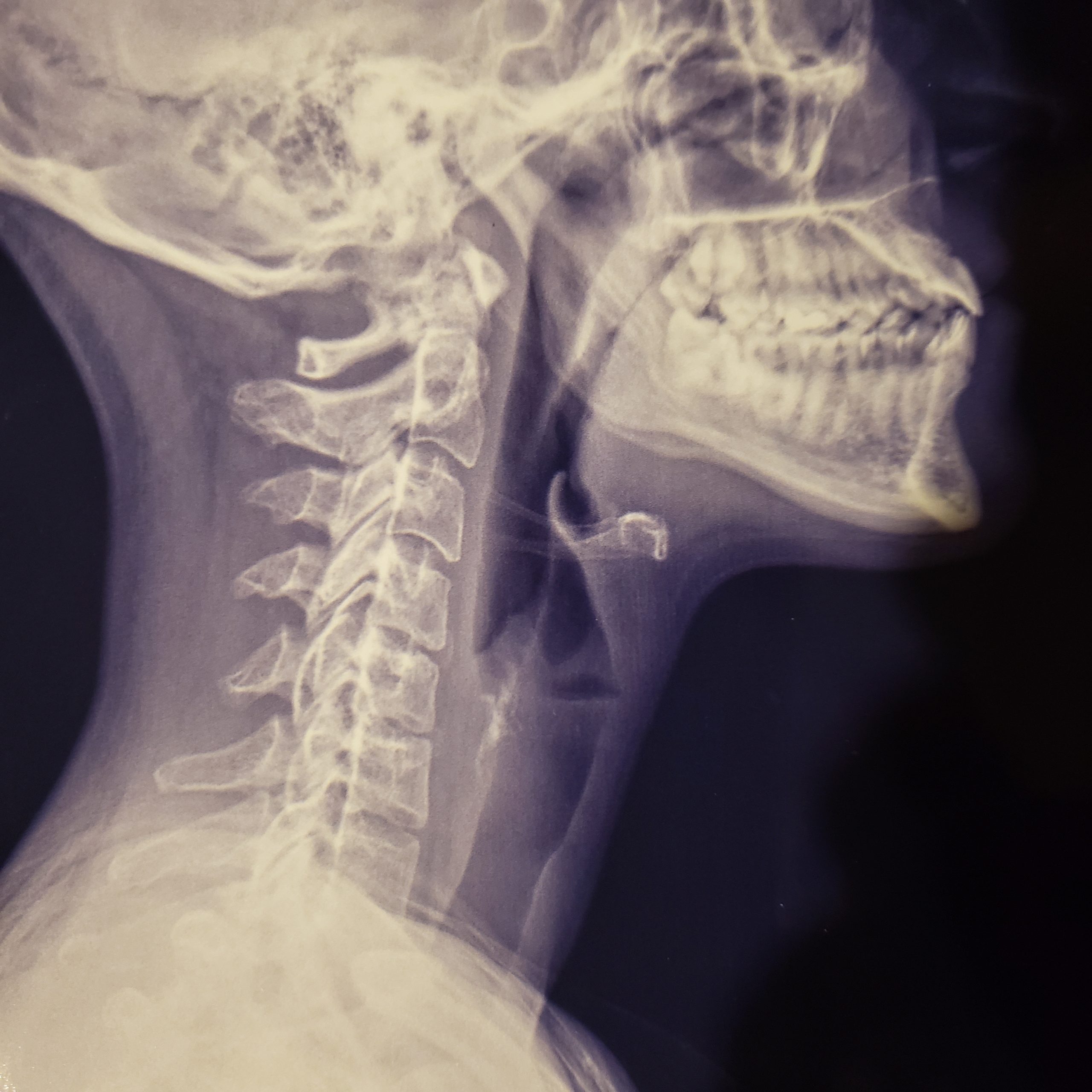 x-ray from chiropractor practice before mi-trac treatment in loganville, georgia