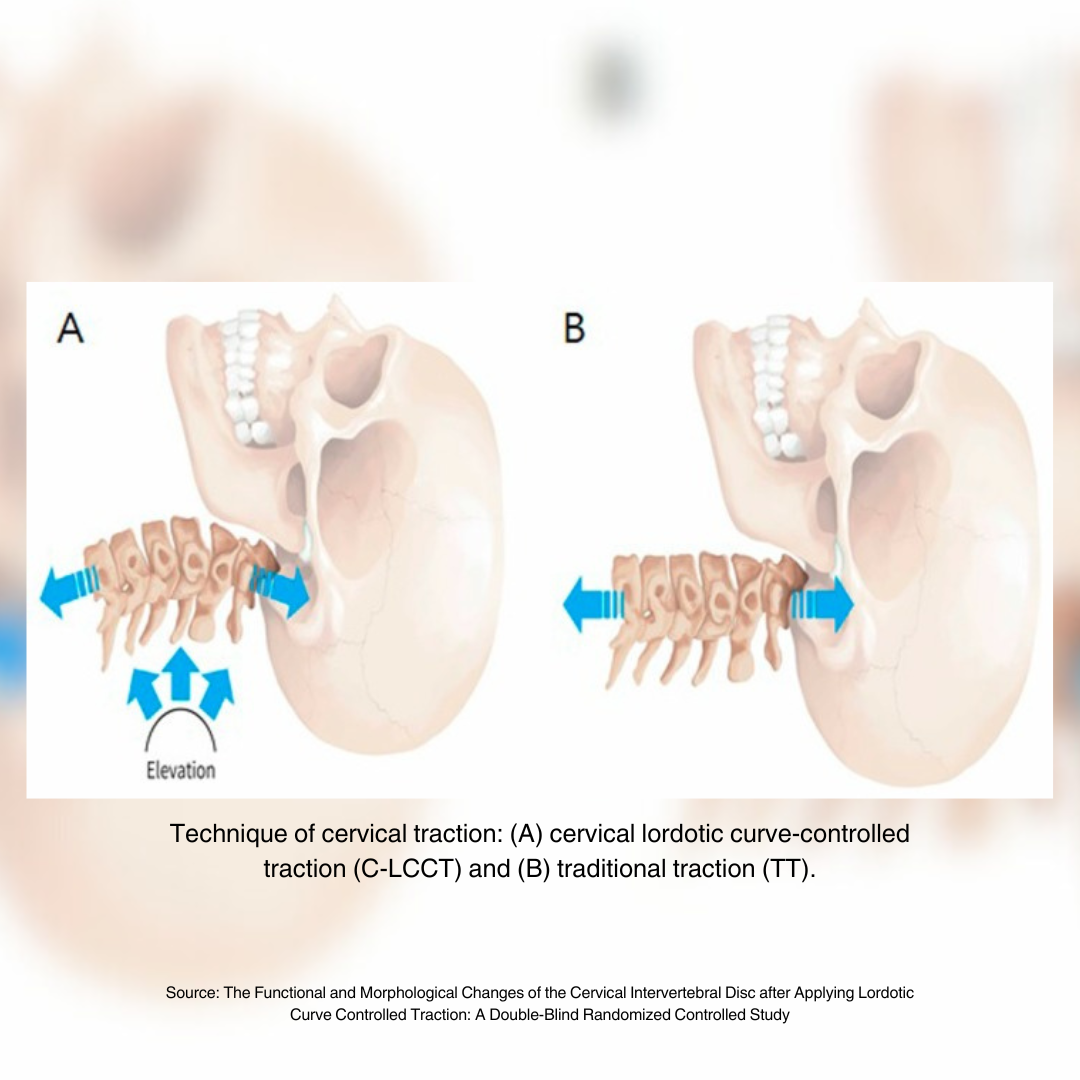 Image of the functional and morphological changes of the cervical intervertebral disc after applying lordotic curve controlled traction